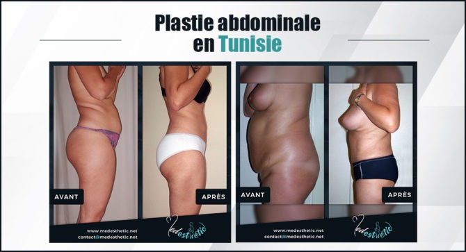 abdominoplastie tunisie plastie-abdominale