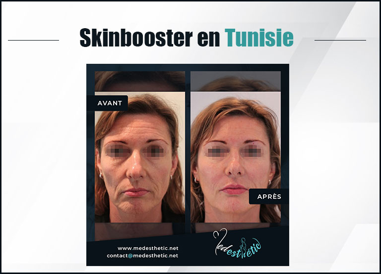 skinbooster