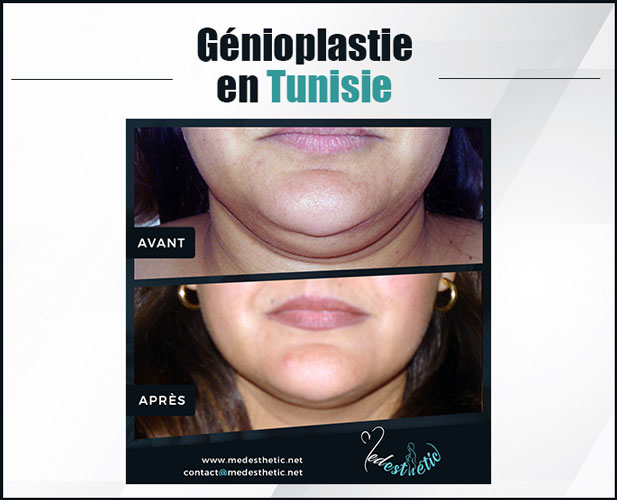 genioplastie en Tunisie