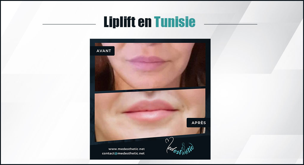 liplift en tunisie