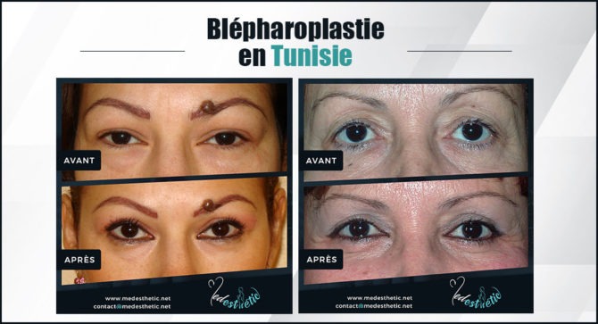 blepharoplastie tunisie blepharoplastie