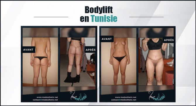 bodylift Tunisie body lift en Tunisie