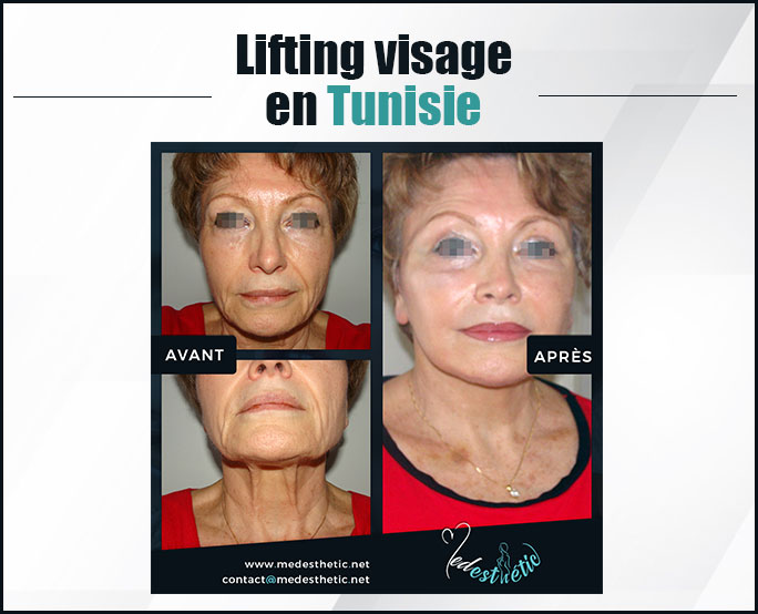 lifting visage Tunisie