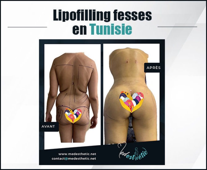 lipofilling tunisie lipofilling fesses en tunisie