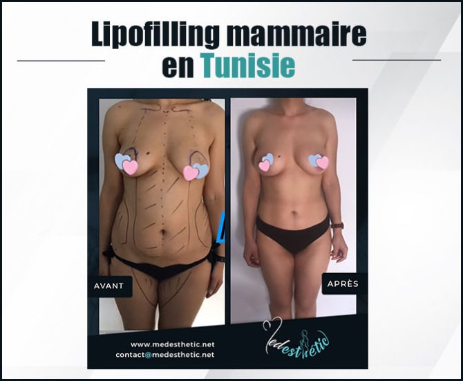 lipofilling mammaire tunisie lipofilling_mammaire