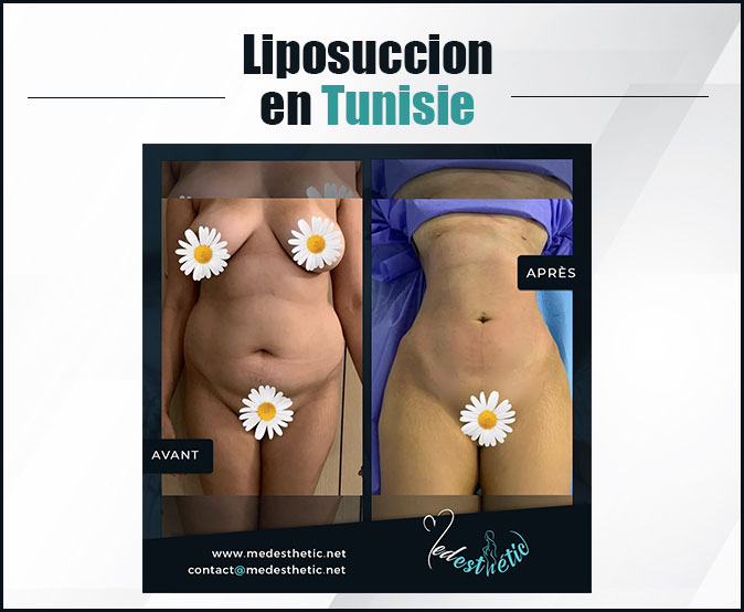 liposuccion