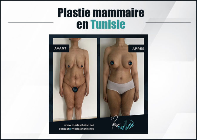 Lifting seins Tunisie plastie-mammaire