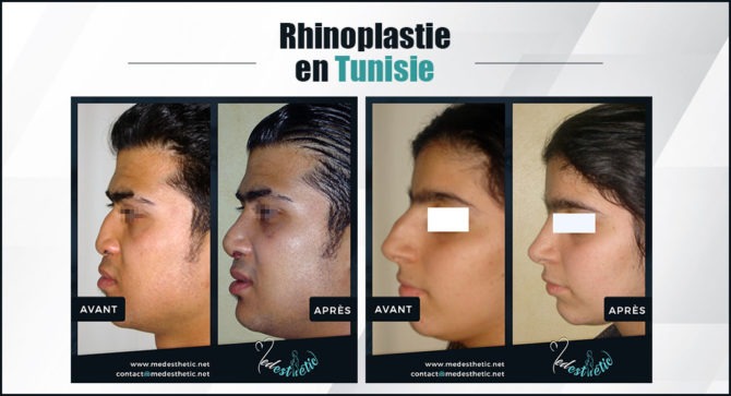 rhinoplastie tunisie rhinoplastie