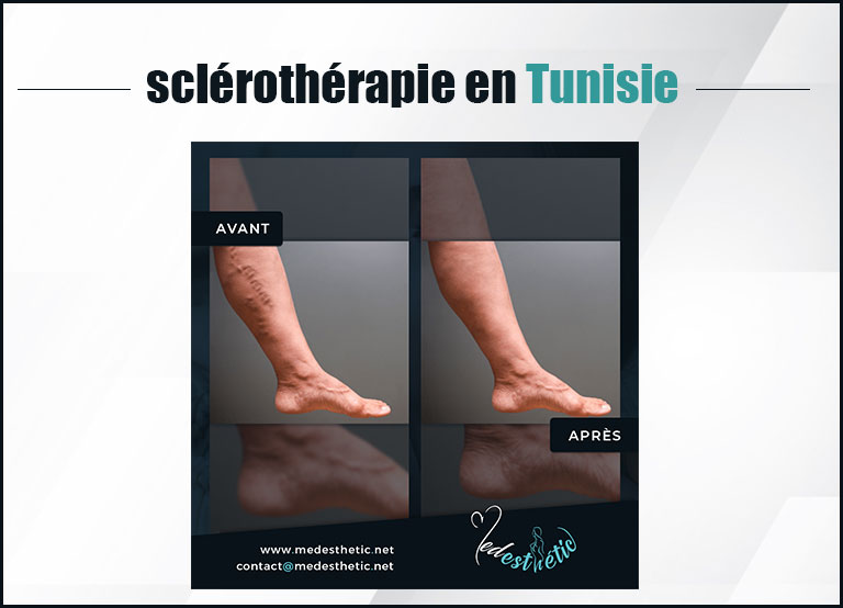 sclerotherapie