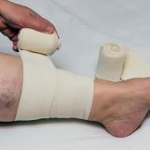 Treatment of varicose veins