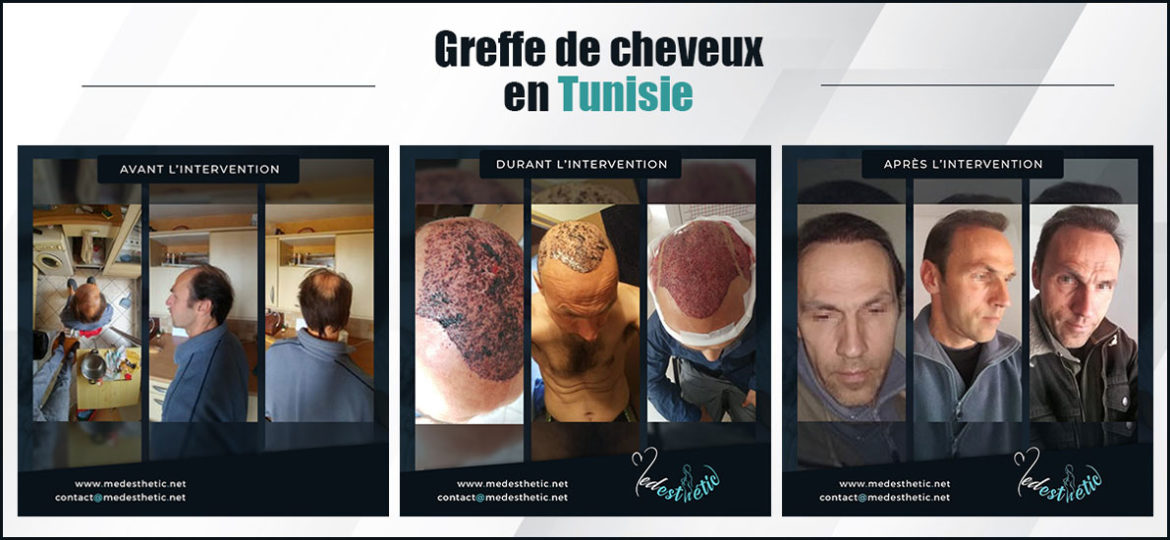 greffe-de-cheveux