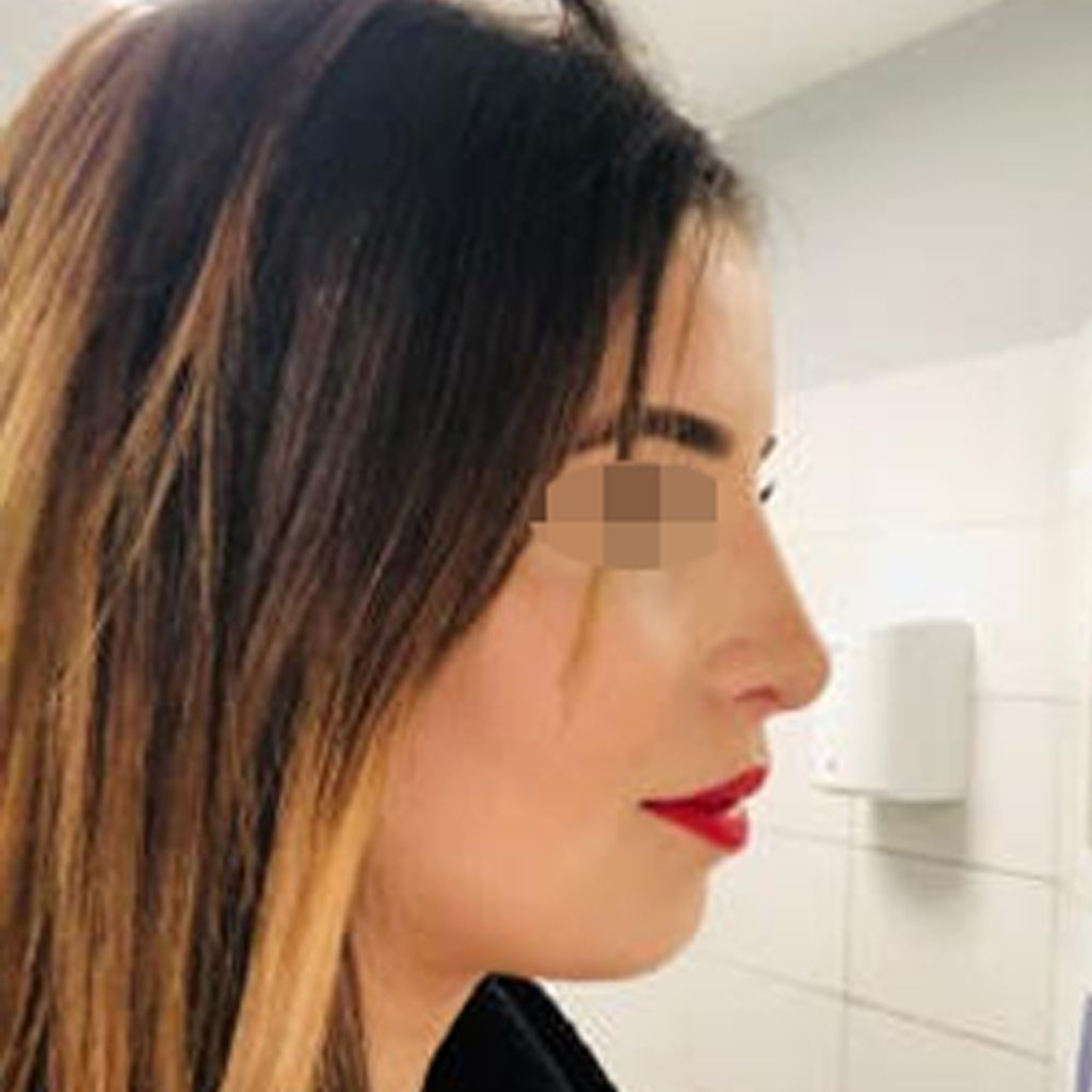 apres rhinoplastie tunisie