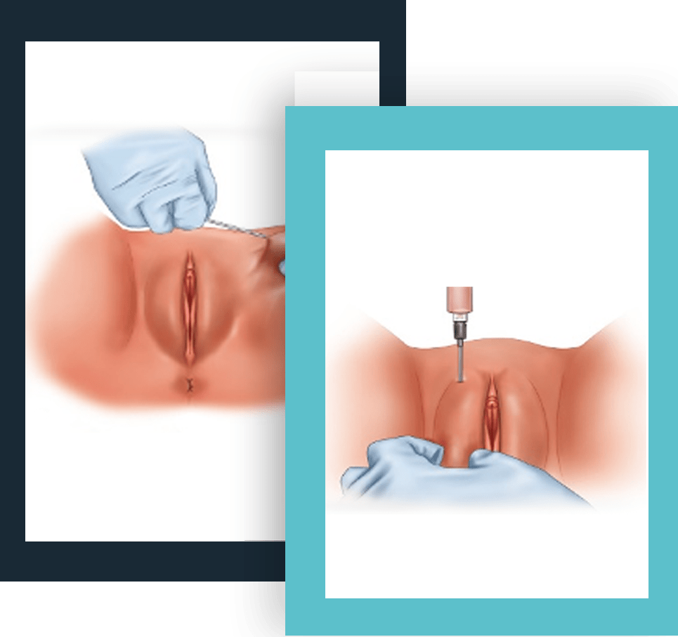 augmentation_levres_vaginales_tunisie