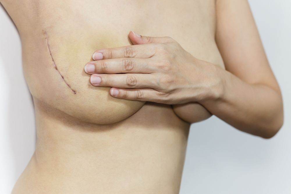 Cicatrices après une chirurgie esthétique : comment les faire disparaitre ?