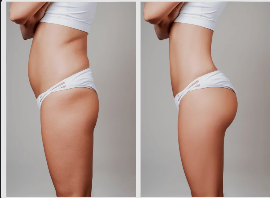 Liposculpture : remodeler son corps, découvrez les différentes nouvelles technologies de liposuccion