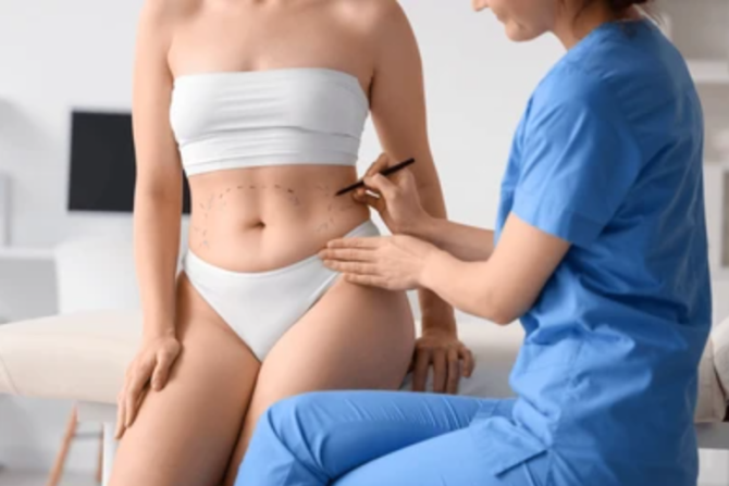 Liposculpture